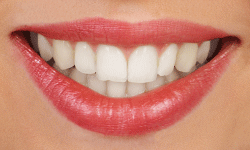 Ceramic Braces are less noticeable and allow for a comfortable fit
