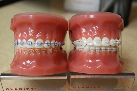  Clarity™ Ceramic Brackets | Dentist | Pershing Orthodontics | Tri-City NE